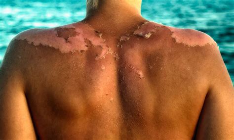 .i had my chart rectified a little while ago and it turns out that i am a cancer rising (which was a couple of signs off from what i thought my rising sign was, virgo). Recent Study Shows How Sunscreen, Not the Sun, Causes ...