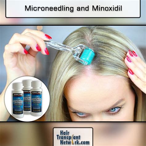 So, which needle length is best for hair loss? Microneedling and Minoxidil | Microneedling, Minoxidil ...