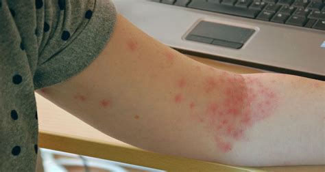 This causes widespread inflammation which. Otras afecciones dérmicas | BlueCap