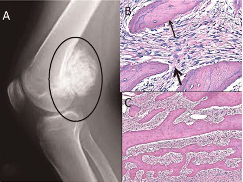 Osteosarcoma, osteosarcoma presentation, osteosarcoma radiology, osteosarcoma pathology roll over the images for more information. X-ray of parosteal osteosarcoma (ring) showing surface ...