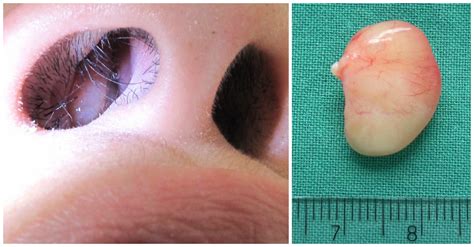 Such polyps are caused due to condition such as asthma, recurring infection. 4 Scary Signs And Symptoms Of Nasal Polyps