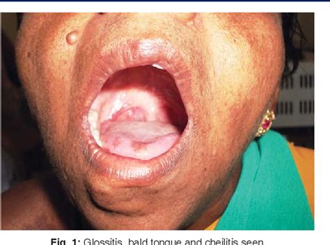 The iron deficiency is typically chronic and severe. Figure 1 from A Case of Plummer-Vinson Syndrome Esophageal Web Dysphagia treated by Dilatation ...