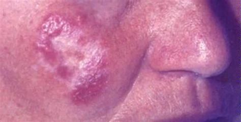 The skin lesions had developed from a cervical lymph node tuberculosis. Tuberculosis Cutis Luposa - Zdravlje
