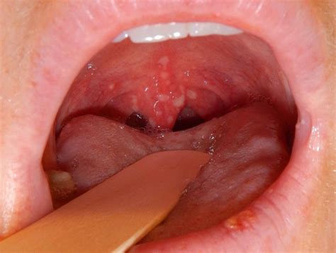 Many of these infections are viral; Herpangina: Symptoms, causes, and treatment