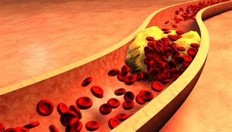 Triglycerides are the most common type of fat in the body. The Myth About LDL Bad Cholesterol Debunked - New Health