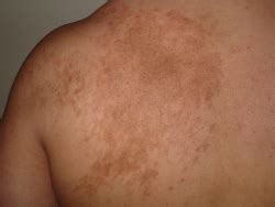 The rash was like red sores, no blistering and no pain as he didn't notice contrary to popular symptoms, john did not have a cough. Covid-19 Image Examples | Opu Labs