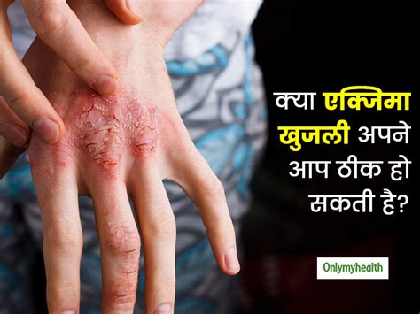 When it lasts for a long time, there is a risk for complications in both infected men as well as women. How Long Does Eczema Symptoms Last Without Treatment in ...