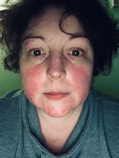 Maybe you would like to learn more about one of these? Lupus can cause a red butterfly-shaped rash across the ...
