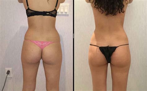 They will not go away. Inner thigh lipo before and after 6 (Görüntüler ile)