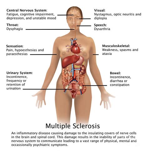 For some children, however, adem develops into ms. Symptoms Of Multiple Sclerosis Photograph by Gwen Shockey