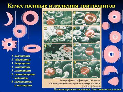 Анемия постгеморрагическая диета Патофизиология системы крови. Постгеморрагическая анемия Патофизиология системы крови. Постгеморрагическая анемия Анемия постгеморрагическая диета