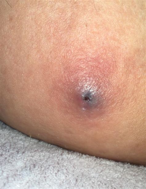 Ingrown hairs are hairs that curl and grow back into your skin after shaving or waxing. What is this on my inner thigh? Please help! : popping