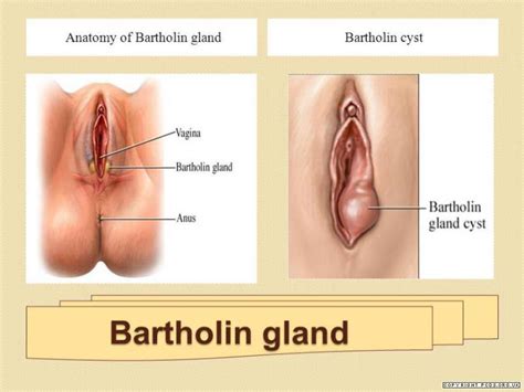 Letakkan ais pada kelenjar parotid atau testis untuk melagakan kesakitan. Cara Merawat Bartholin Cyst Dengan Berkesan