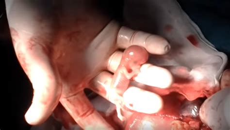 Pregnancy, process of carrying young in the womb; Ectopic pregnancy videos reveal unmistakable humanity of ...