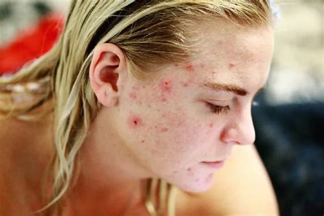 Malos hábitos diarios que producen acné | Bezzia