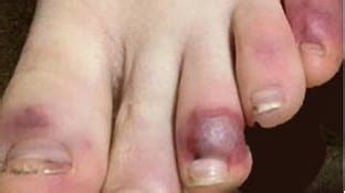 This time after exposure and before having symptoms is called the incubation period. 'COVID toes': Mystery skin rash could be symptom of ...