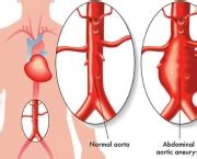 A aorta é o principal vaso sanguíneo do corpo. Aprenda Um Pouco Mais Sobre o Aneurisma | Saúde - Cultura Mix