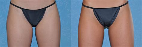 Our experience was very bad based exclusively on the customer service. CoolSculpting® Case 169