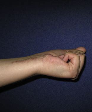 Treatment treatment orthopaedics j true. One-stage treatment of delayed 'jersey finger' by z-step ...