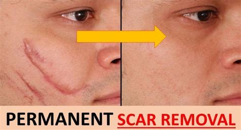 Scar removal creams can reduce the appearance of scars & help to improve texture and make scars smaller. Pin on Beauty