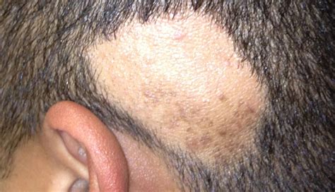 Derm Dx: Sudden onset hair loss - Clinical Advisor