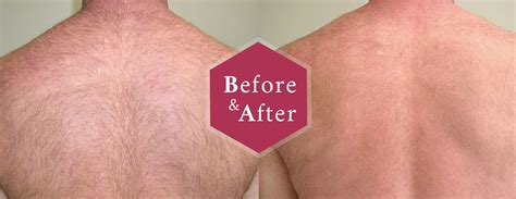 Laser hair removal can be a costly but effective way to get rid of the unwanted hair people are sick of shaving, trimming or waxing. Shoulder Laser Hair Removal: Easier and Quicker than Ever ...