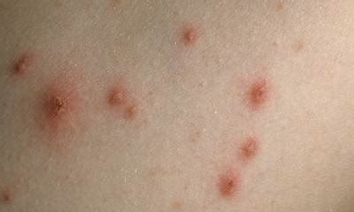 However, the initial joy is cut short when more possible threats although chicken pox itself isn't any serious threat to your baby, it may, at times, lead to serious complications like pneumonia. Chicken pox in babies symptoms pictures, chicken pox in ...