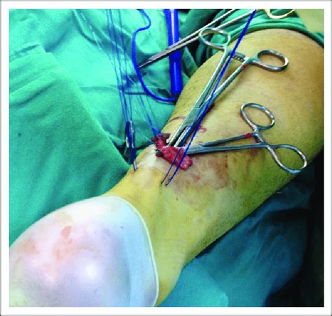 Tendon, tissue that attaches a muscle to other body parts, usually bones. Suturation of distal tendon end with the clamp. Sutures ...