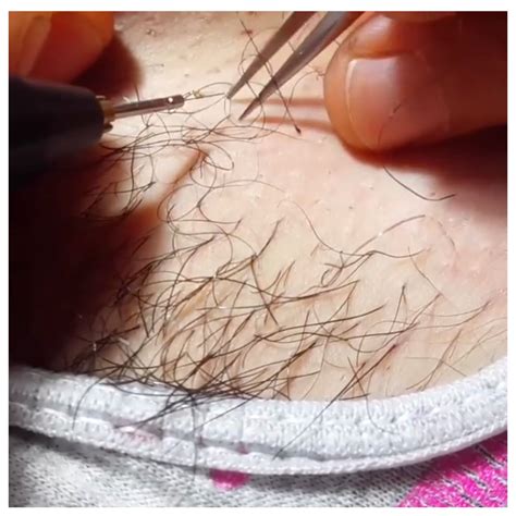 Electrolysis is done by a professional who places a tiny needle with an electric current in the hair follicle. Electrolysis Hair removal | Hair removal, Electrolysis ...