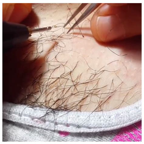 Today's electrolysis procedures are quicker and more adaptable. Electrolysis Hair removal | Hair removal, Electrolysis ...