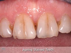 Sometimes, dentists can get rid of coffee stains during a biannual cleaning. Teeth Staining Causes and Remedies