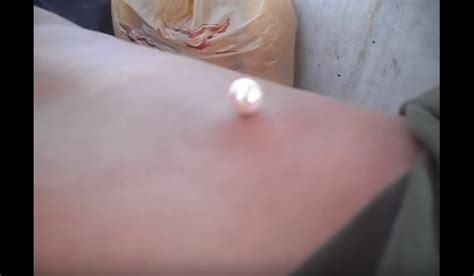 This is true especially when the lump is small and is not accompanied with any infection. how to drain a cyst with no head | New Pimple Popping Videos