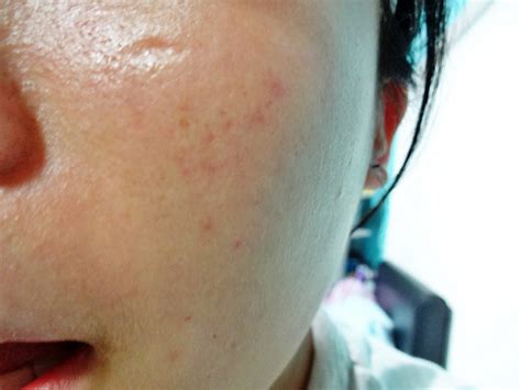 This is the only product that helps me fade my dark post acne marks. mshuiling : Review: Hiruscar Post Acne