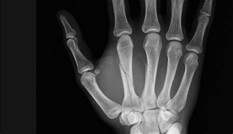 Frattura del metacarpo della mano e della falange | Symcro.it
