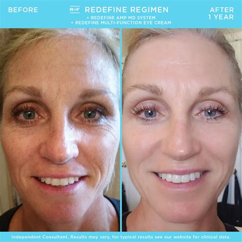 20 Rodan and Fields Before and After Pictures That Will ...