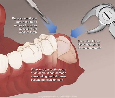 Almost all dental insurance schemes cover up to 40 to 60 percent of the total cost of removing the cost of extracting a wisdom tooth depends on the condition of the tooth and standard dental charges existing in a region or city. How Many Wisdom Teeth Does A Person Have - Boston Dentist ...