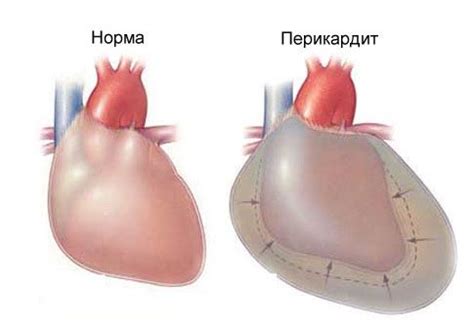 Learn about symptoms, diagnosis and treatment for pericarditis — a condition involving inflammation of tissue surrounding the heart. Rimane dolore al petto: cause, sintomi, trattamento | Con ...