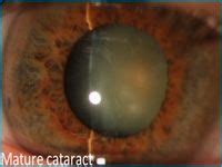 How much does laser eye surgery cost? 17 Best images about Cataract surgery cost on Pinterest ...