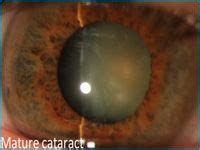 How much does laser eye surgery cost? 17 Best images about Cataract surgery cost on Pinterest ...