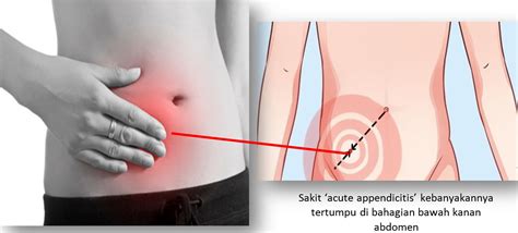 Maybe you would like to learn more about one of these? Acute Appendicitis - PORTAL MyHEALTH