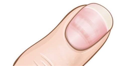 Melansir science insider, arti pertanda warna putih di kuku jari dari tanda kuku leukonychia. 5 Tanda-Tanda Penyakit Yang Dapat Di Lihat Melalui Kuku ...