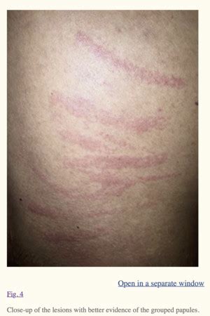 傳染性肺炎 、 流感疫苗 、 官兵體檢. 獨／高雄男身體浮現「鞭打痕」 好兄弟出手抓？醫曝驚人真相 | ETtoday健康雲 | ETtoday新聞雲