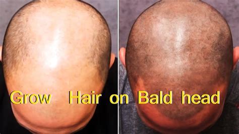 Most people are eager to regain their hair back to how it once was after growing hair back from bald, and the treatment has successfully overcome hair fall. Grow Hair on Bald head - SIMPLE METHOD | Grow hair, Beauty ...