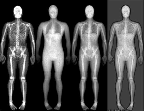 It involves increased osteoblast activity. Diet's Effect on Osteoporosis - Ornish Lifestyle Medicine