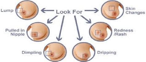 Breast cancer can have different symptoms for different people. Signs of Breast Cancer | Download Scientific Diagram