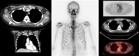 Pet/ct is a vital diagnostic imaging tool and is especially effective in revealing conditions such as cancer and brain disorders. FDG uptake in sternoclavicular joint synovitis: Mimic of ...