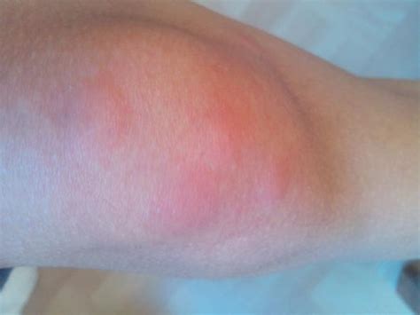 Molecular diagnostics of hepatitis c virus infection: Rote Flecken/Bisse am Knie. Wanzen -, Floh -, oder ...