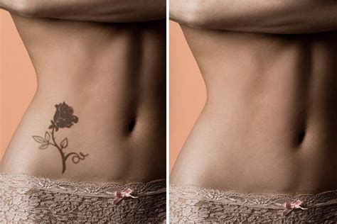 We did not find results for: Tattoo Removal Procedure ~ IAmJeni