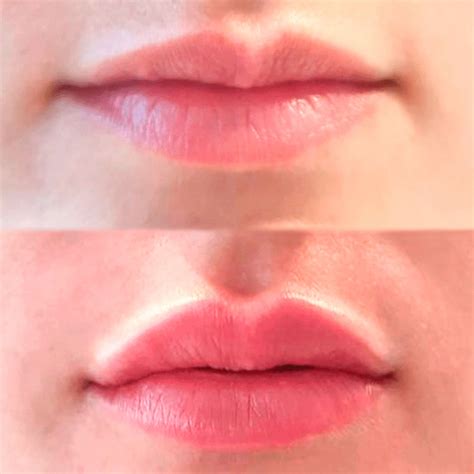 Видео hyaluronic lip fillers (pen) !! Success case in a lip filler treatment with hyaluronic ...