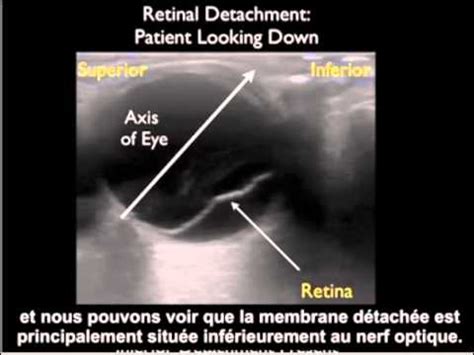 We did not find results for: Echographie oculaire seine et marne | echographie oculaire ...